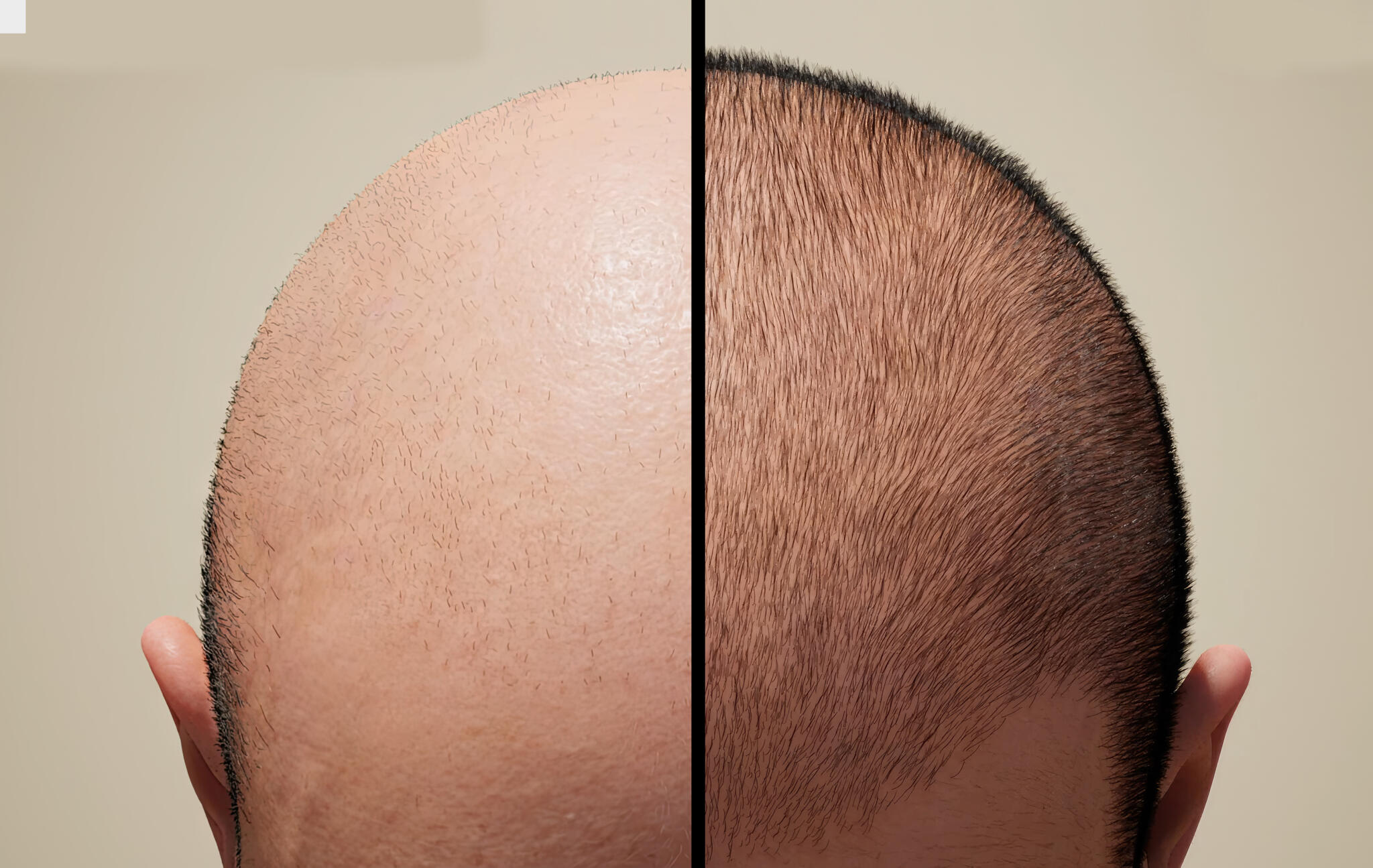 TOP-10 myths about hair transplantation