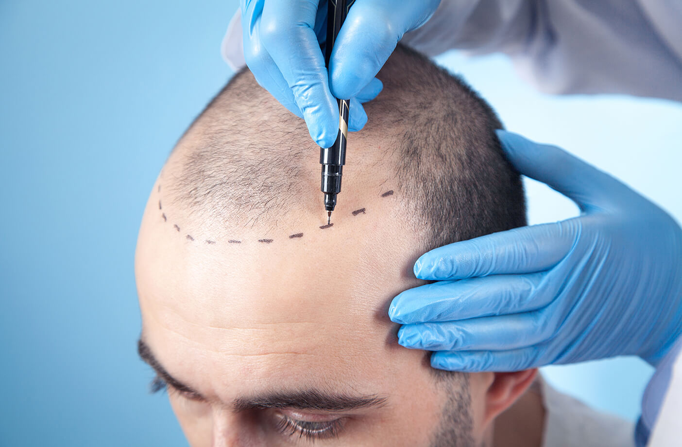 Rehabilitation after hair transplantation: detailed instructions